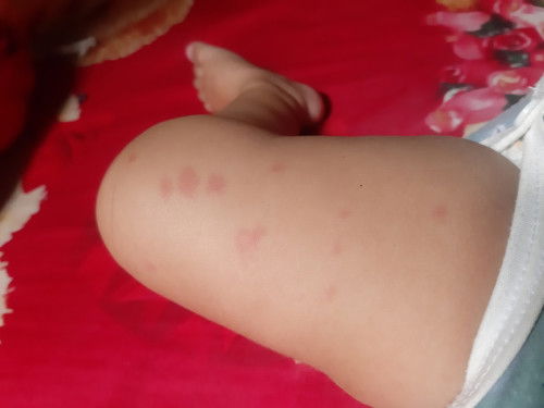 Kulit bayi merah merah