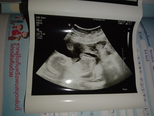 ลุงหมอสูติบอกว่าน่าจะได้ลูกสาวเพราะเห็นไม่ชัดยังไม่ชัวร์