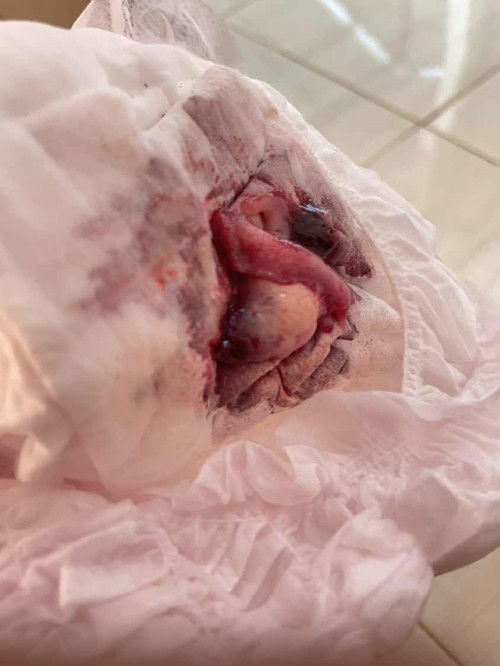 มีก้อนไหลออกมาหลังคลอด7เดือน