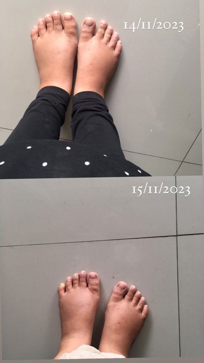 Kaki bengkak hamil 19 minggu