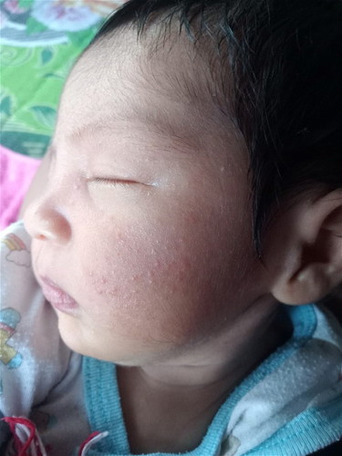 ผื่นที่หน้าลูก