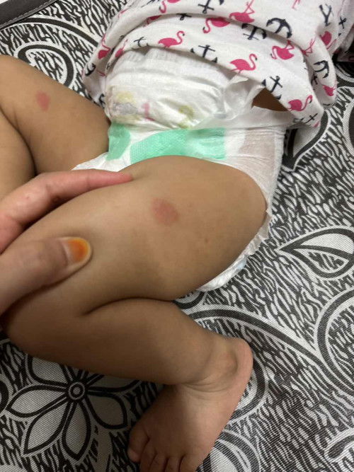 Tanda merah besar di badan anak