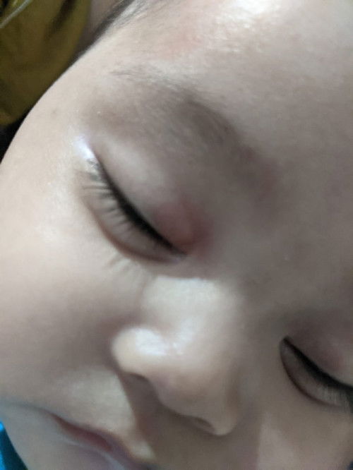 Pojok Mata Bayi Merah