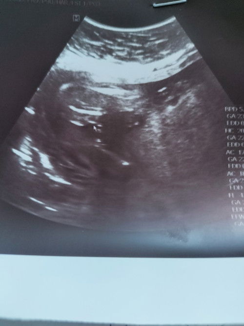 แม่ๆช่วยดูว่าน้องเพศอะไรหมอบอกว่าน้องเป็นผู้ชาย