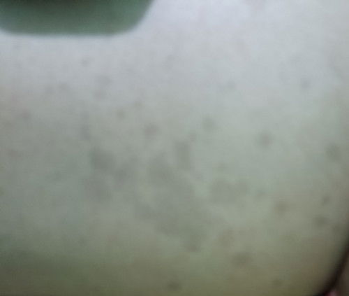 Bund ada yang ngalami di paha ada bercak hitam begini, ini kenapa ya ?
