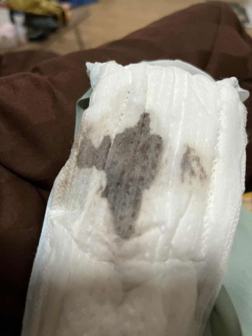 แม่บ้านไหนเลือดออกขณะตั้งครรภ์ไหมคะ7week