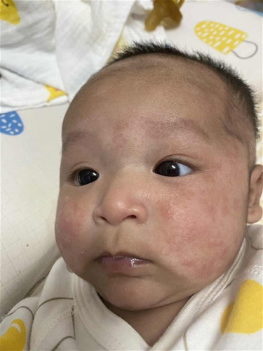 หน้าลูกน้อยแดง