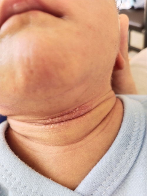 น้องเป็นผื่น