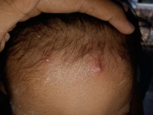 Alergi? Pada anak umur 1 tahun 6 bulan