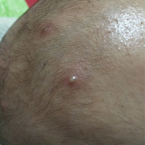 Jerawat pada kulit bayi