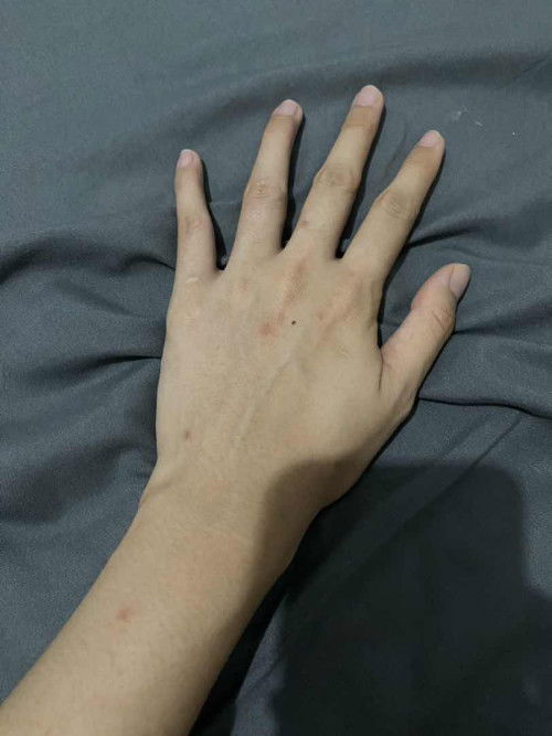 14w muncul bintik2 merah gatal😭😭