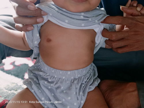 Benjolan d puting payudara bayi umur 7 bulan