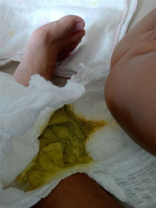 อุจจาระแบบนี้อันตรายมั้ย