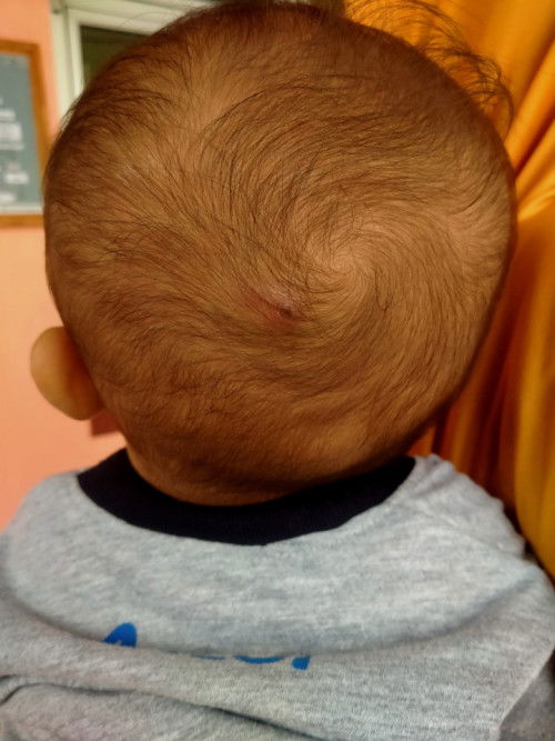 Bentol bernanah di kepala anak