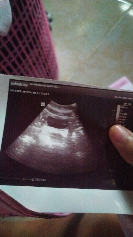 Mau tanya itu kta dokter rahim sehat bersih tp penantian 3thun bestii😢