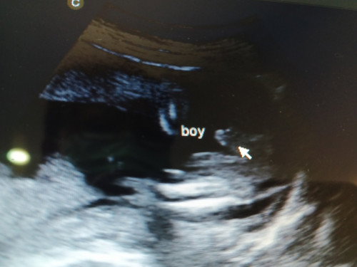 Gender sa Ultrasound