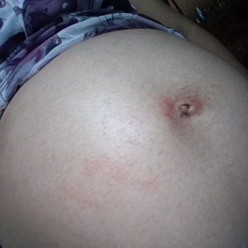 Ano po ,kaya pwedeng igamot or  Ointment ?  6 mnths 3days