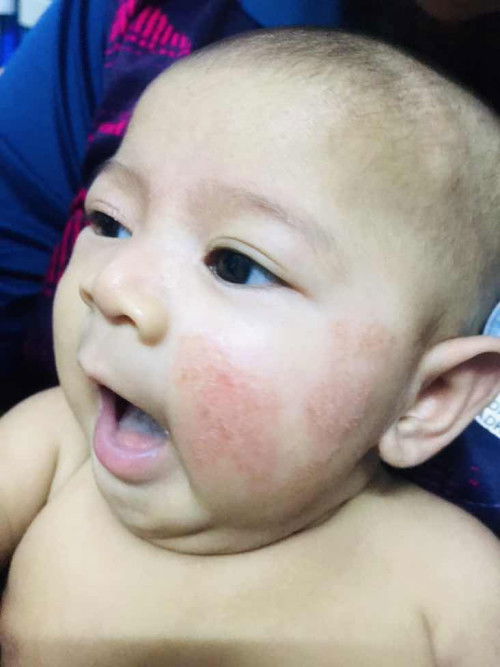 Assalamualaikum…baby sy baru nk masuk 3 bulan so nak tanya klu naik mcm ni ruam ke eczema ye?