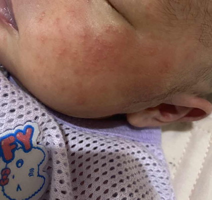 Ruam merah dekat muka baby