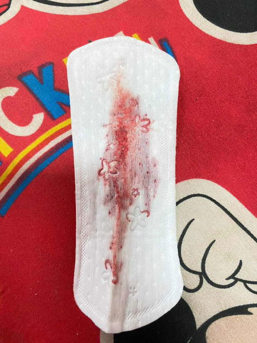 17/11/66วันนี้มาแชร์ประสบการ หลังย้ายตัวอ่อนมาได้6Wวันนี้ มีเลือดออกทางช่องคลอดแต่ไม่มีอาการปวดหน่วง รีบไปหาหมอ ตรวจ