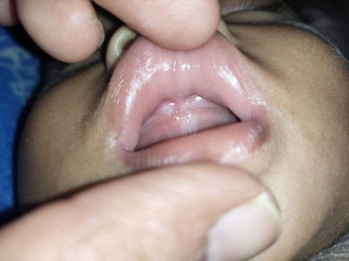 ฟันซี่บน 7 เดือนจะเข้า 8 เดือน