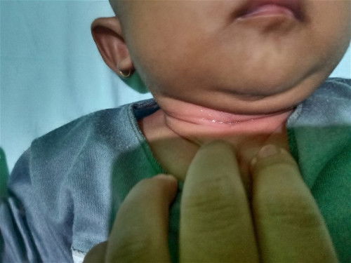 Lecet pada leher bayi