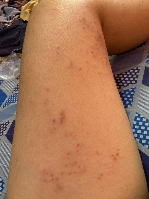Skin allergies