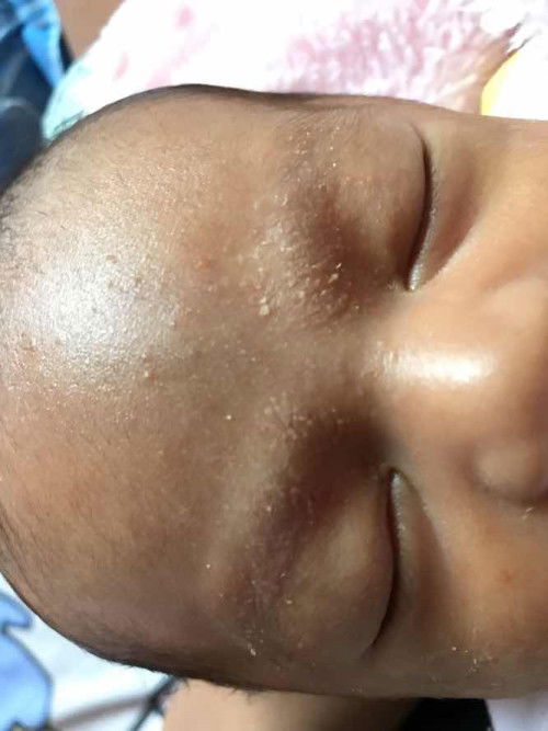 เป็นผื่นที่คิ้วมันคือผื่นอะไรคะจะหายไหม😀