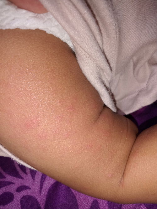 Bintik2 merah kaya biang keringat