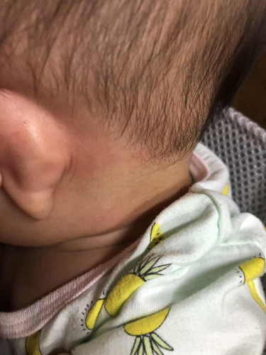 Baby rashes