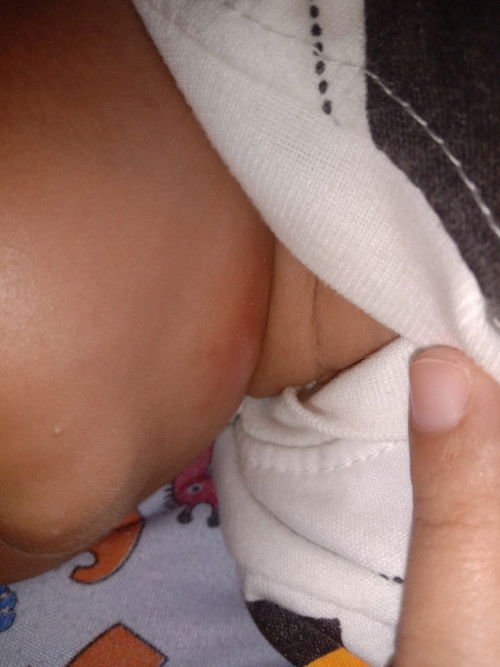 Bentol merah agak keras di bawah dagu bayi usia 2 bulan 20 hari