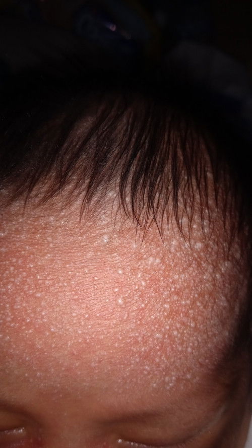 Biang keringet atau saraf