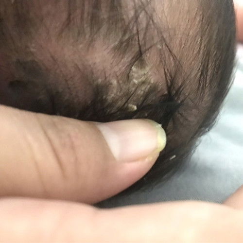 kepala bayi berkerak