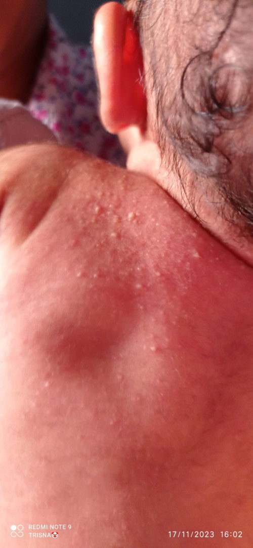 Ada bruntus di pundak bayi