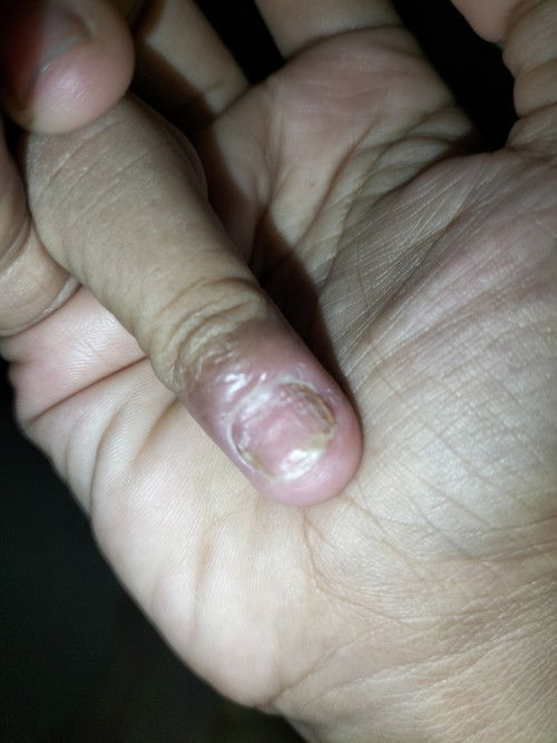 Obat kuku bergelombang dan kuning pinggir