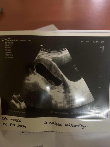 Miscarriage