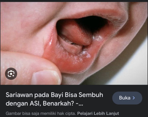 Sariawan atau bekas susu atau jamur