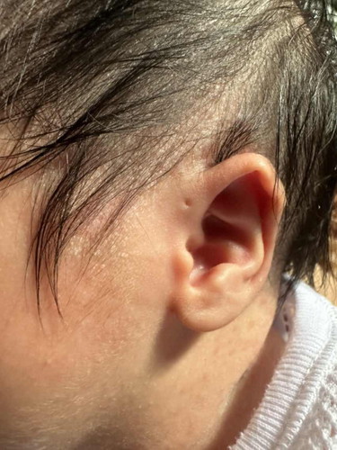 Preauricular sinus? Siapa ade pengalaman ade lubang kecil ni?