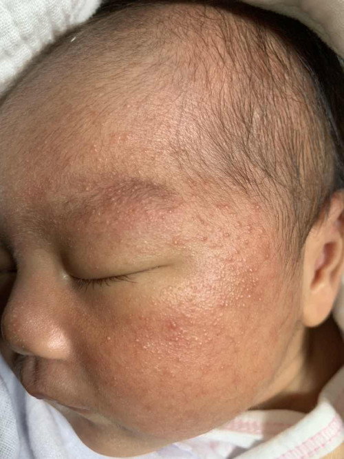 น้องอายุได้10วัน ผื่นขึ้นแบบนี้มีลูกบ้านไหนเป็นแบบนี้บางคะ