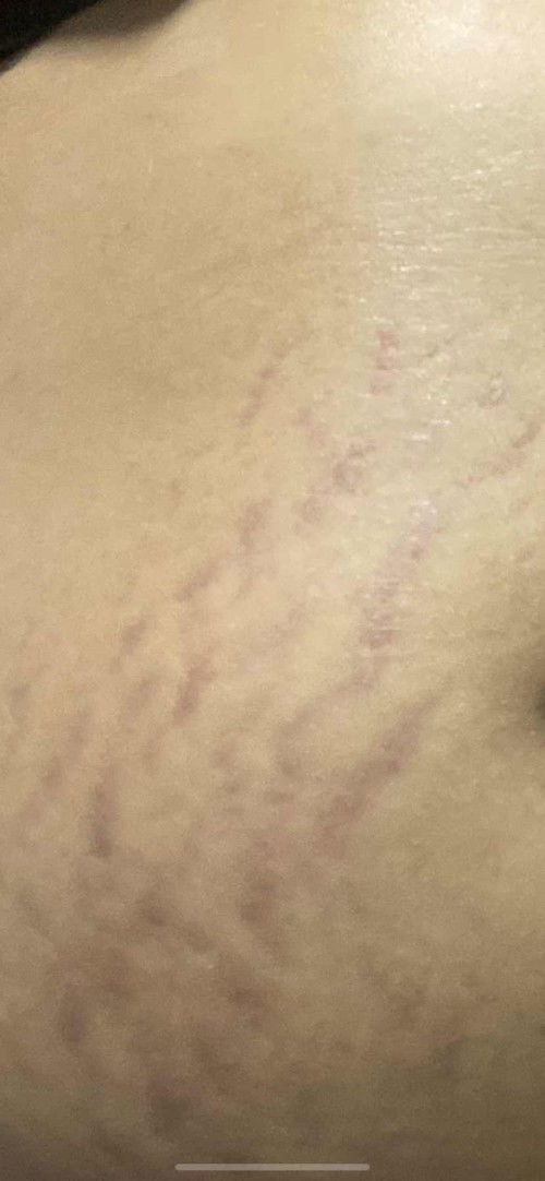 รอยแบบนี้มีโอกาสหายไหมคะ