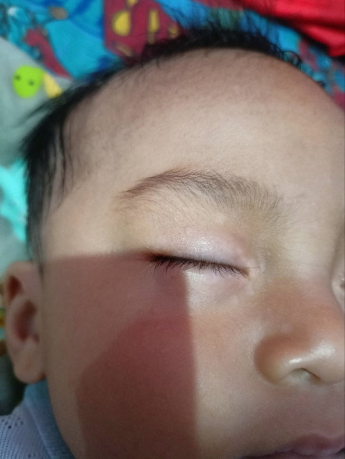 Kelopak mata bayi bintik bintik putih