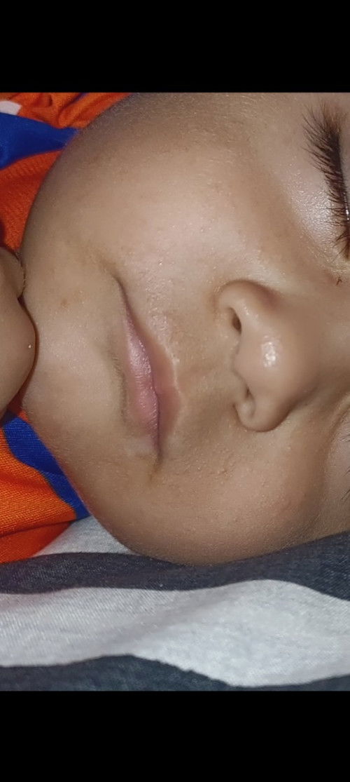 มีผื่นแบบนี้เกิดจากอะไร ทาอะไรถึงหายคะ