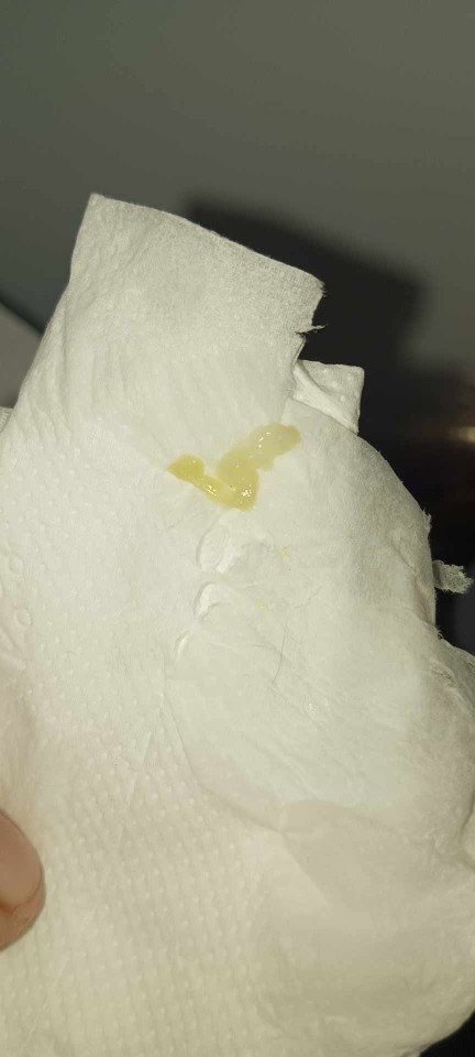 yeast infection???