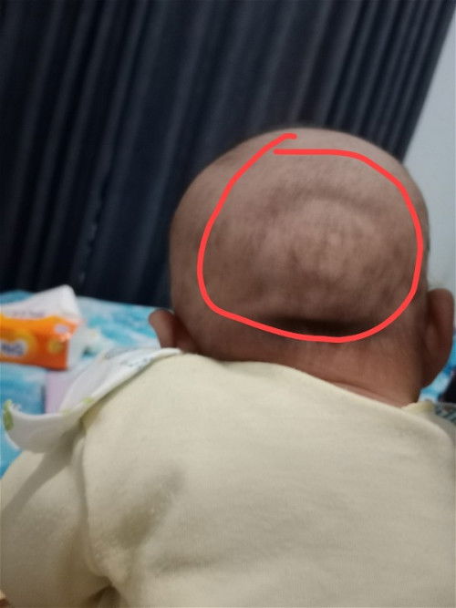Kepala belakang bayi tidak rata