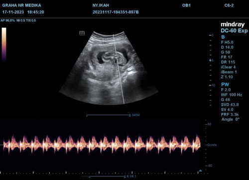 Usg 12 minggu bayi lagi tengkurep