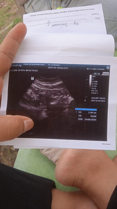 Sharingbun#
Bunda mau tanya ini temen aku di USG ada kantong janin. Tapi setiap di tespek negatif.