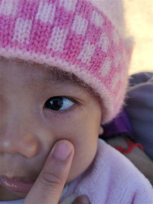 ลูกอายุ 3 เดือน มีห้อเลือดเป็นจุดที่ใต้ตาและเปลือกตามีที่หน้าผาก แบบนี้ลูกเป็นอะไรค่ะแม่ๆ