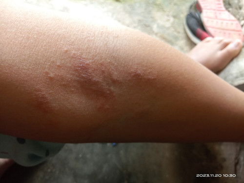 Wajar gak sih bun klw hamil ngalamin gatal gatal pada kulit.. Kayak kadas gitu bun, sampek hitam