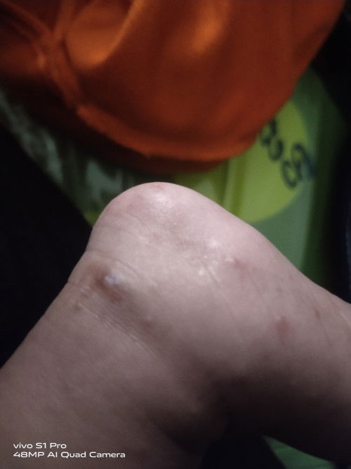 Kulit bayi bintik bintik