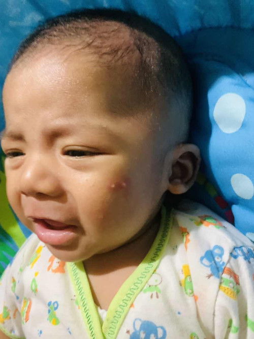 Muka anak tb2 muncul beruntus kayak jerawat